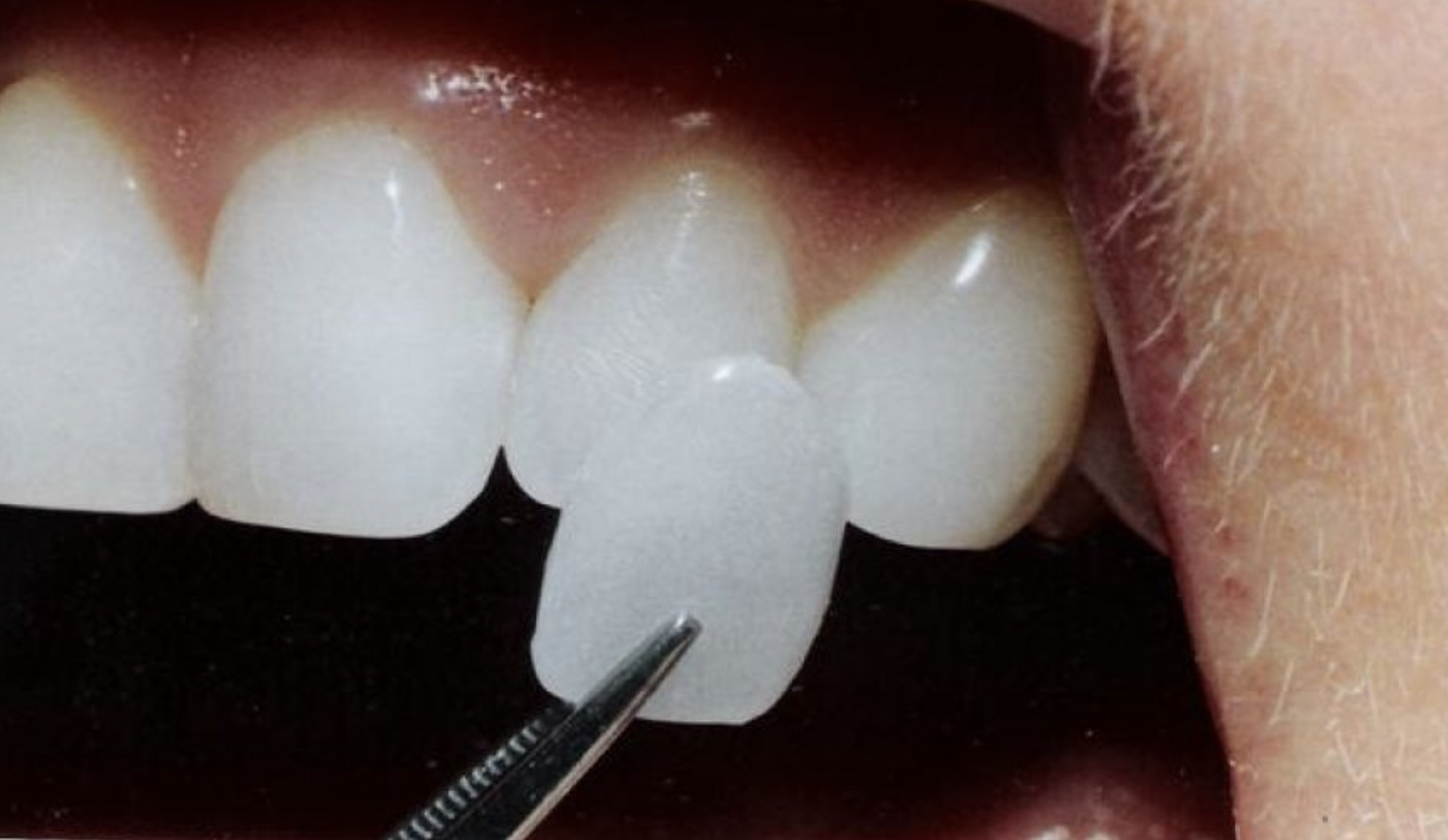 Lamina Diş Kaplama: Diş Hekimi Ali İhsan Erkan ile Estetik ve Doğal Gülüş