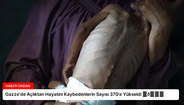 Gazze’de Açlıktan Hayatını Kaybedenlerin Sayısı 370’e Yükseldi ⏬👇