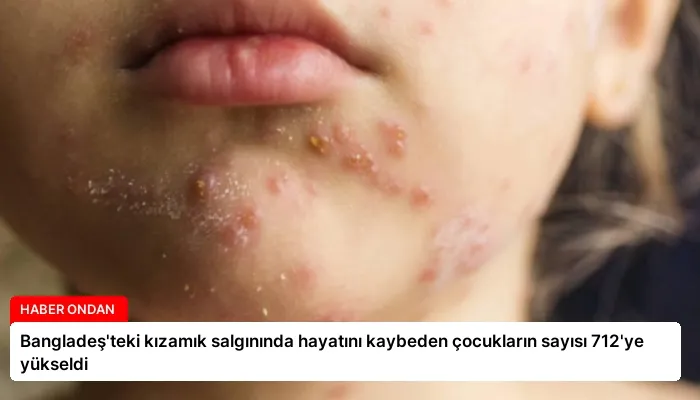 Bangladeş’teki kızamık salgınında hayatını kaybeden çocukların sayısı 712’ye yükseldi